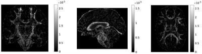 Improving the Predictions of Computational Models of Convection-Enhanced Drug Delivery by Accounting for Diffusion Non-gaussianity
